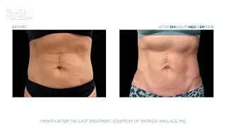 Emsculpt Neo Technology in Brickell at Miami Skin Spa
