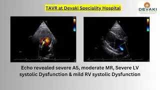 TAVR at Devaki Speciality Hospital Madurai by Dr.Rufus Demel Interventional Cardiologist.