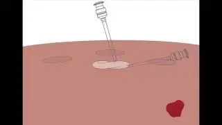 Morcellation Bag  Animation