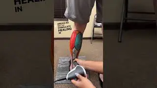Как лечить растяжение / разрыв икроножной мышцы