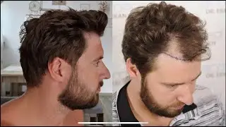 Dr.Erkan Demirsoy 3622 Grafts Fue Before After Photos #beforeandafter #hairtransplant