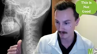 This Spine Was Worse Than I Thought: The Posture Restoration Journey Begins