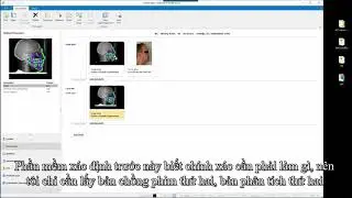Chồng phim so s&aacute;nh kết quả điều trị trong phần mềm ph&acirc;n t&iacute;ch phim sọ Audaxceph