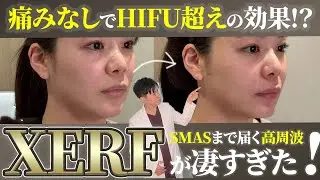 SMAS層まで届く高周波ザーフってなに!?最新たるみ治療の効果はHIFU超え!?３つの照射モードの違いや症例写真もご紹介！