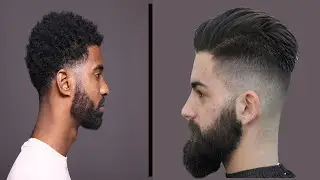 4 REAL Before & After results of FUT hair transplants