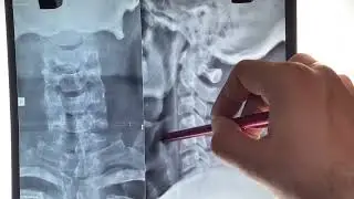 Cervical Spine X-ray, Neck Pain, Cervical Spondylosis, Cervical Disc Bulge, How to Read Neck X-ray 