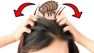 How To Get Rid of Fleas on Human Hair and Treat Flea Bites on Humans