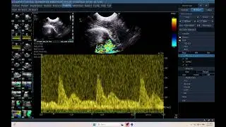 IQ 679 TCD BRAIN ICP CPP ECHOPAC ANALYSIS  ULTRASOUND