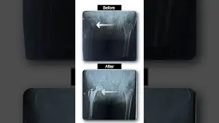Hip Surgery Success Story  | Pain-Free Walk After Surgery | Dr. Vinit Yadav #Shorts