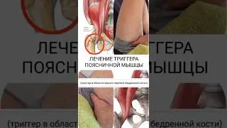 Устранение триггера поясничной мышцы/ Терапия боли и восстановление функции мышцы. #chiropractic