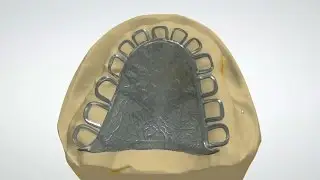 Cobalt Chrome plate strengthener for complete upper denture