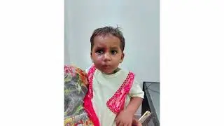 Port wine stain - sturge Weber syndrome