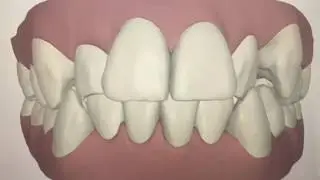 Invisalign at Peggy Bown Dentistry