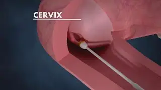 How to Safeguard before Cervical Scraping