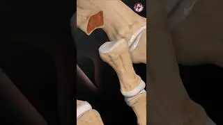 Hammertoe Surgery Explained | RetroFusion Implant Technique