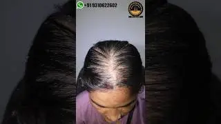 Happy Patients ☺️ | Best Clinic Hair Transplant | Divine Cosmetics Clinic | #shorts #trendingshorts