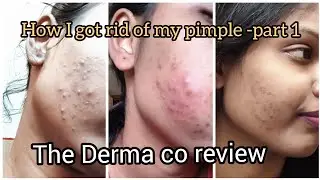 The #Dermaco | pimple | acne solution | dermatologist product| review