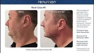 J Plazma &Ouml;ncesi ve Sonrası: Ger&ccedil;ek D&ouml;n&uuml;ş&uuml;mler EN: J Plasma Before and After: Real Transformations