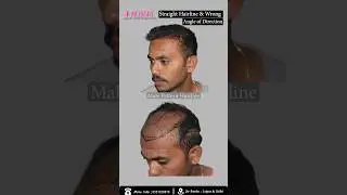 Correction of Wrong Hair Transplant | Hairline Correction and Repair with Results by Dr Suneet Soni