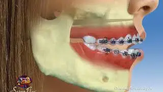 Openbite Surgical