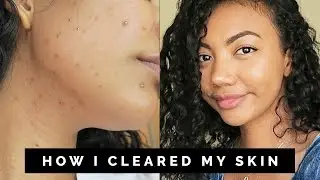 HOW TO CLEAR UP ACNE FAST!!