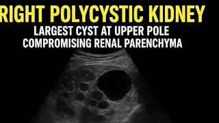 Ultrasound kidney showing polycystic Kidney! Kidney stone!Renal Cyst types!#ultrasoundmadeeasy86#uk 