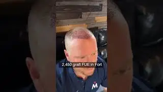 We did this FUE with our Neograft