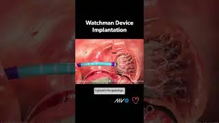 Процедура имплантации Watchman 🫀 при инсульте, связанном с #фиб