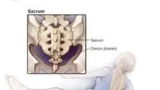 Tailbone pain(coccydynia)/causes/precautions/Treatment