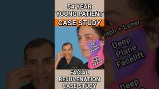 Model&rsquo;s Surgical Case Study #antiaging #cosmetic #skincare #plasticsurgeon