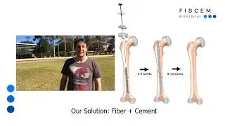 FIBCEM: a biodegradable, fiber reinforced bone cement for femoral fractures