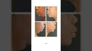 Double Chin Liposuction | J Plasma | Renuvion | Plastic Surgery | Istanbul |Turkey |#shorts