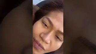 Microbleeding on an old eyebrow 😳