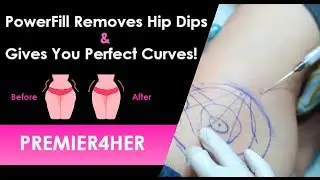 PowerFill for Hip Dip Correction | Non-Surgical Curve Enhancement | Premier4Her