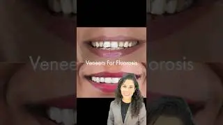 Veneers for brown stained teeth | Fluorosis #shorts #viralvideo #trending #veneers #smilemakeover