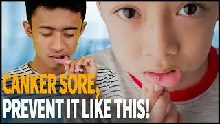 Canker sore, Prevent it like this!