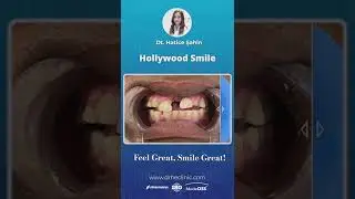 Are you ready for a Hollywood Smile? Change your smile! #shorts