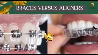 Braces vs Aligners? Adult Smile Solutions Explained! #smilemakeover #dentistry #orthodontics