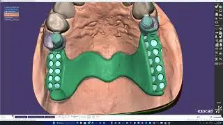 Exocad PartialCAD - Modeling framework design on Attachments
