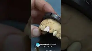 You'll see veneers in a dentist chair. But there is the hidden side of this delicate work.