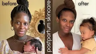 how i cleared my skin postpartum | fall skincare routine