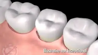 Encinitas CA Periodontist Provides Patient Education - Lanap Video of Periodontal Disease Treatment