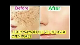 3 Days Blackheads Challenge, Permanently Close Open Pore for Oily skin
