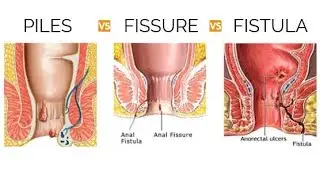 My first video| Fistula | Fissure | piles journey | Ano- Rectal diseases  #Fistula   #piles #Fissure