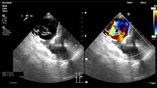 Severa insufficienza tricuspidale trattata per via percutanea con Triclip e supporto ECMO