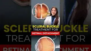 Scleral Buckle Surgery | Retinal Detachment Treatment