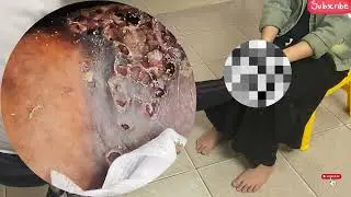 Severe Jigger Outbreak &ndash; Hidden Damage Beneath the Skin! #OJ376