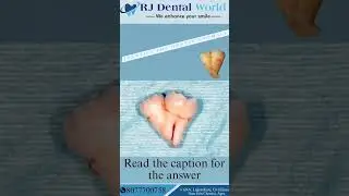 Identify the Dental Anomaly.........Concrescence