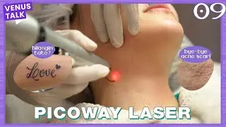 [MyVenus] Kulit Mulus Tanpa Noda dengan Picoway Laser 🔫