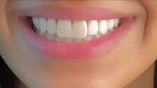 ღ your teeth are literally perfect! ~ veneers procedure 💉